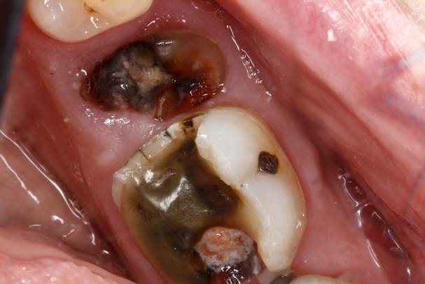 root canal treatment singapore