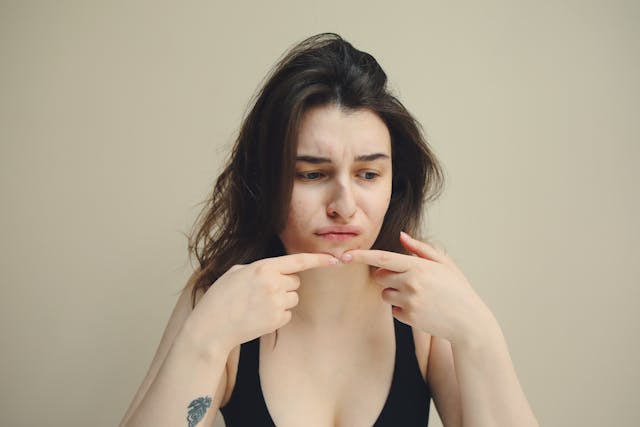 Cystic Acne Treatment in Singapore (2025)