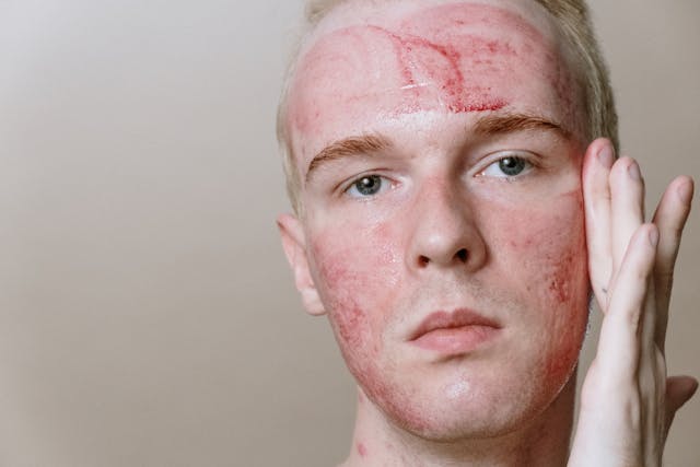 Post-Inflammatory Erythema (PIE): Causes, Treatment, and Management